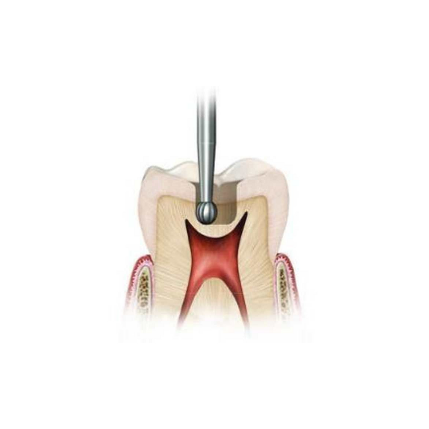 Ss White Surgical Length Carbide Fg Burs